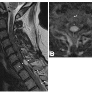 A Pre Operative Sagittal T2 Weighted MRI Of The Cervical Spine