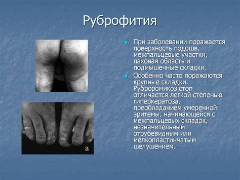 Грибковые заболевания кожи. Занятие №5 - презентация онлайн