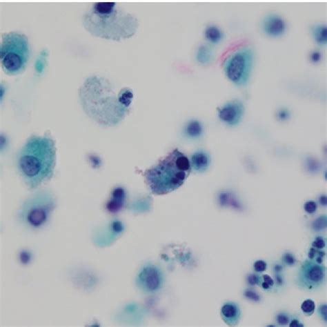 Histopathology Of The Brain Lesion A Amoebic Trophozoites Are Present