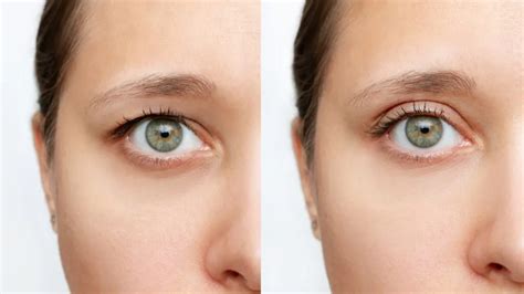 Maximizing Scar Healing After Eyelid Surgery