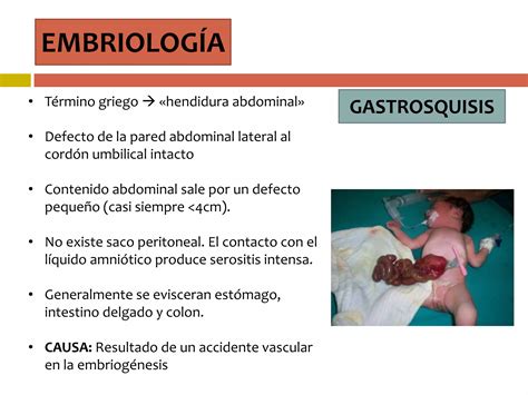 Gastrosquisis Y Onfalocele Ppt