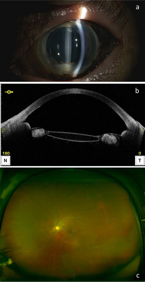 Case Os One Month Postoperative Findings A B Slit Lamp