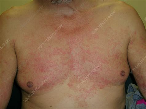 Ringworm Rash On Chest