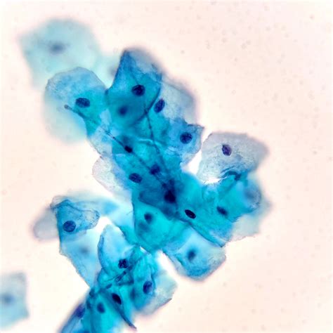 Pathology Outlines Candida Fungi