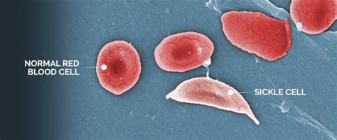 Can Gene Therapy Cure Sickle Cell Disease