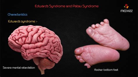 Edwards Syndrome And Patau Syndrome Youtube