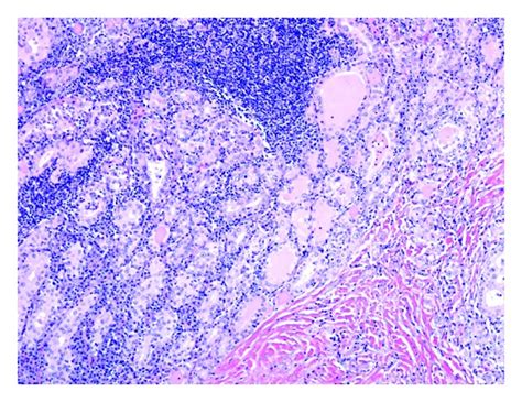 Hashimoto Thyroiditis There Is Extensive Lymphocytic Infiltrate With