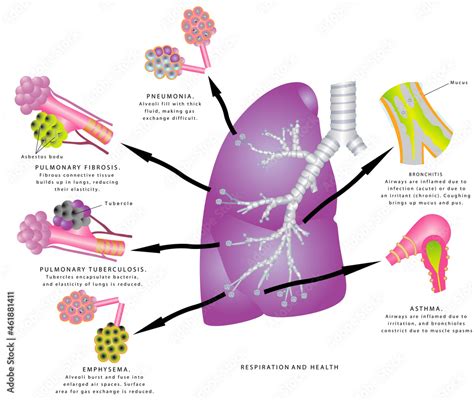 Respiration And Health Upper And Lower Respiratory Tract Infections