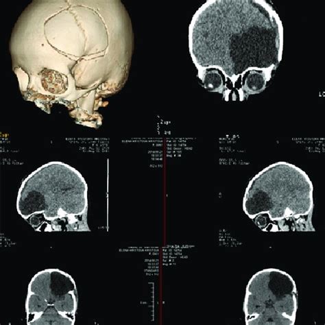 Postoperative Ct After Fronto Parietal Craniotomy With Visibly Total