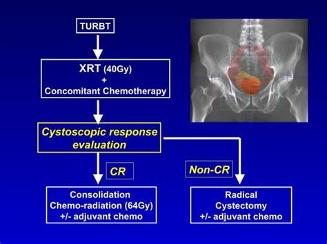 Bladder Sparing Trimodality Therapy For Muscle Invasive Bladder Cancer