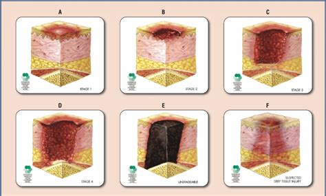 Pressure Ulcer Diagram