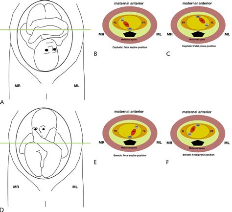 Radiologists Guide To Diagnosis Of Fetal Cardiac Anomalies