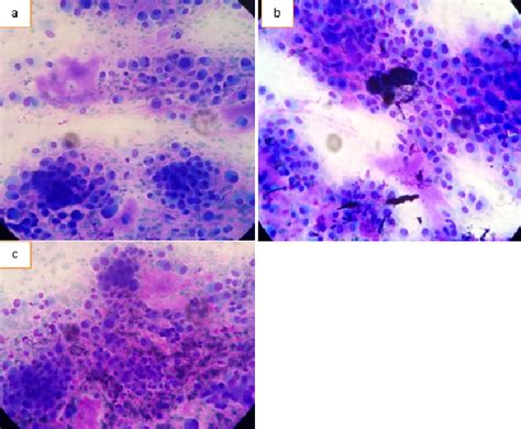 Figure From Case Report Giant Chondroid Syringoma Of The Eyelid