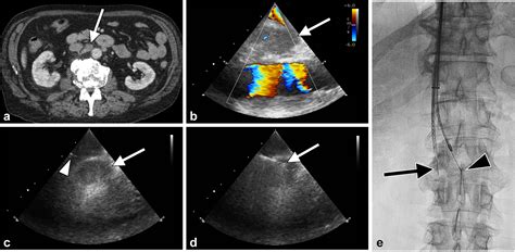 Intravascular Ultrasound Guided Transvenous Biopsy Of Retroperitoneal