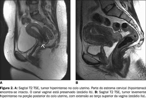 Scielo Brasil Resson Ncia Magn Tica No Estadiamento Dos Tumores De