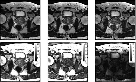 Deep Learning Accelerated T2 Weighted Imaging Of The Prostate