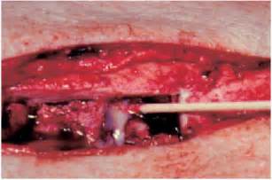 Surgical Treatment Of Osteomyelitis Musculoskeletal Key