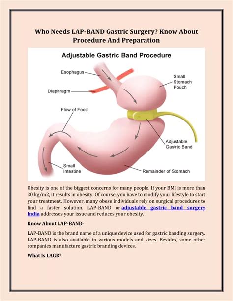 PPT - Who Needs LAP-BAND Gastric Surgery Know About Procedure And ...