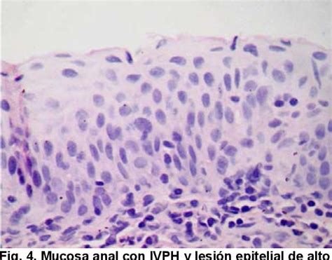Neoplasia Intraepitelial Anal Semantic Scholar