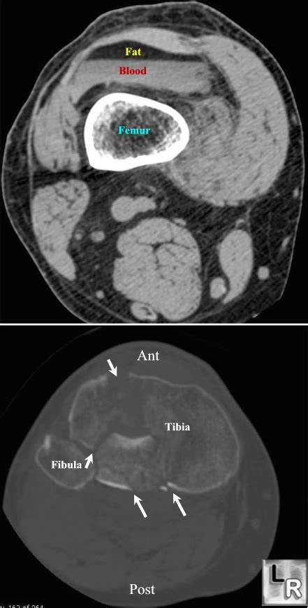 Learningradiology Lipohemarthrosis Hemarthrosis