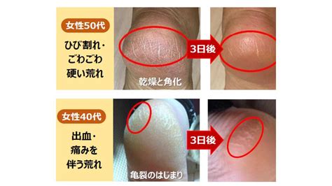 【冬のかかとガサガサ問題】皮膚科医が教える、かかとの荒れがツルツルに変わる「生活習慣＆ケア」 ヨガジャーナルオンライン