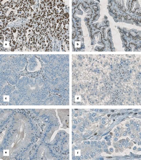 Baf A Expression In Ovarian Carcinomas Immunohistochemical Staining