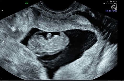 Ultrasound Demonstrating Fetal Pole Consistent With 13 Weeks Gestation