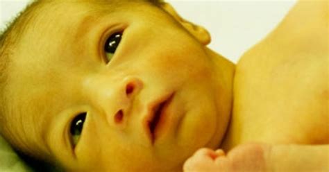 Understanding Newborn Baby Jaundice | HOME HEALTHCARE IN DUBAI