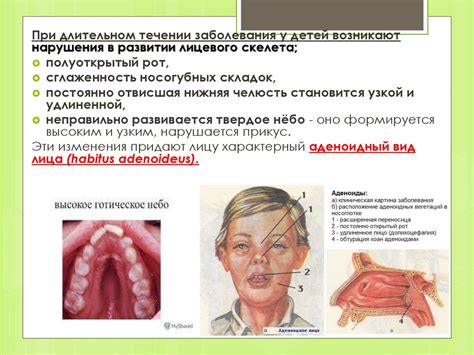Гипертрофия небных миндалин. Гипертрофия носоглоточной миндалины ...
