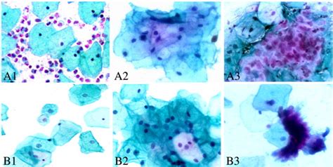 Superficial Squamous Cells And Endocervical Cells Stained By