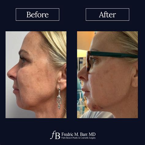 Injectable Dermal Filler Surgery In West Palm Beach Fl