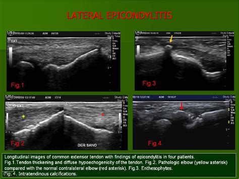 Elbow Joint Ultrasound