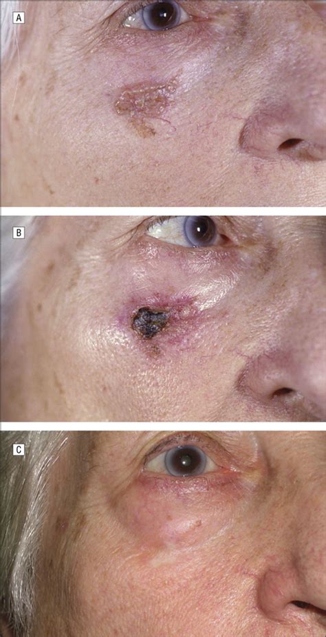 Fifty Five Basal Cell Carcinomas Treated With Topical Imiquimod Outcome At 5 Year Follow Up