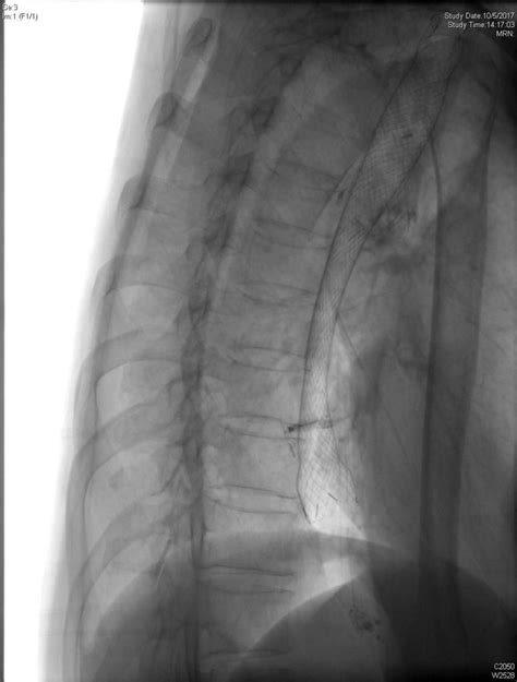 Stricture Stenosis Dilatation Stenting Endoscopy Hk Surgeon