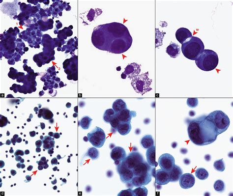 Malignant Cells In Pleural Fluid