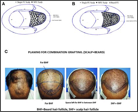 A After Scalp HF Implantation In Norwood Grade IV B After Beard HF