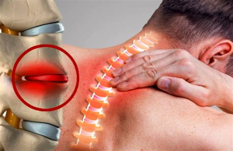 Enfermedad Discal Lumbar y Lumbalgia Revista Salud Médica