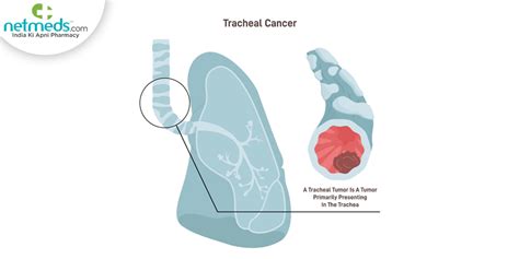 Tracheal Cancer