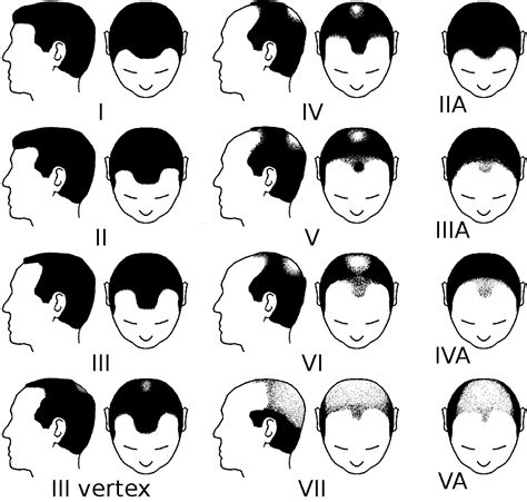 Hamilton Norwood Scale For Male Pattern Baldness Norwood Scale