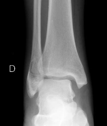 Distal fibular fracture (basic) | Radiology Reference Article ...