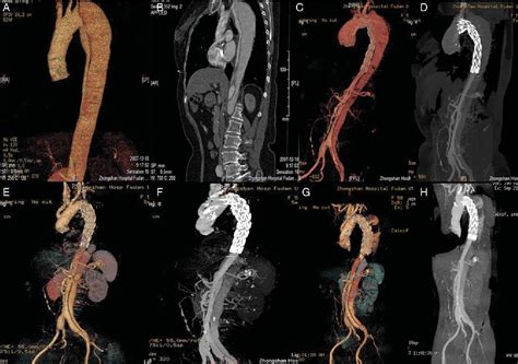 Figure 2 From Surgical Treatment For Retrograde Type A Aortic