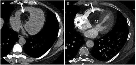 Invasive Lipoma Of The Interventricular Septum A Rare Benign Cardiac