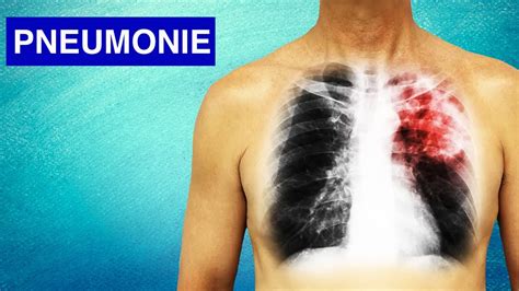 Pneumonie Symptômes Diagnostic et Traitements YouTube