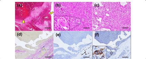 Histopathological Findings Of The Resected Specimen A Hematoxylin And