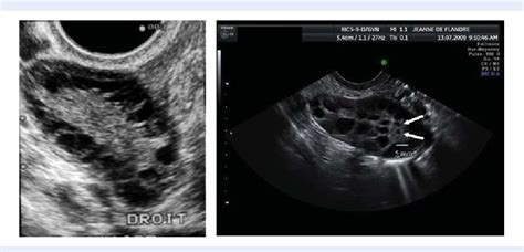 Figure 1 From Diagnosis Of Polycystic Ovary Syndrome PCOS Revisiting