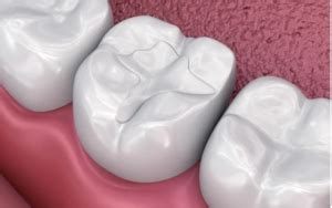 Composite Resin Fillings: A Complete Review - Web DMD