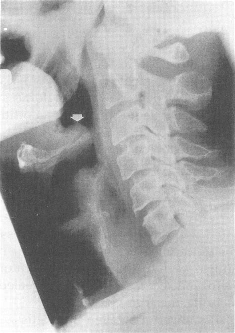 Adu,lt epiglottiS-arrow iiidicates swollen epiglottis. | Download ...