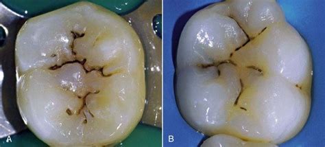 Why Do I Have Black Lines On My Teeth Quora