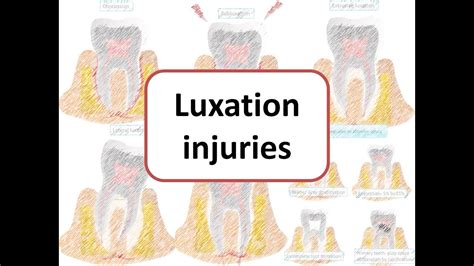 Luxation Injuries: Concussion, Subluxation, Extrusive, Lateral ...