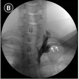 Patterns Of Thoracic Sympathetic Block Sb Showing Successful Sb